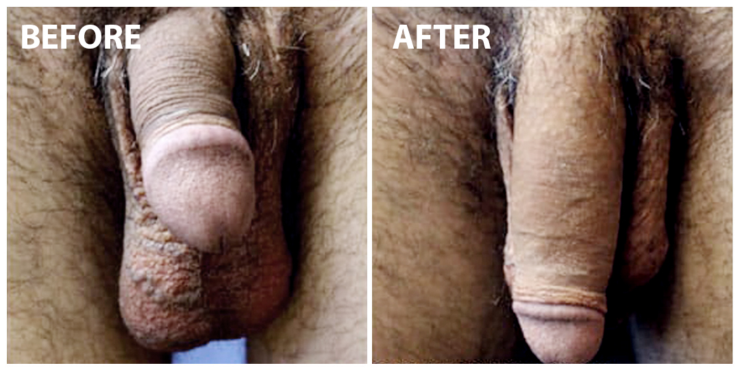 Penis Enlargement Before After 02