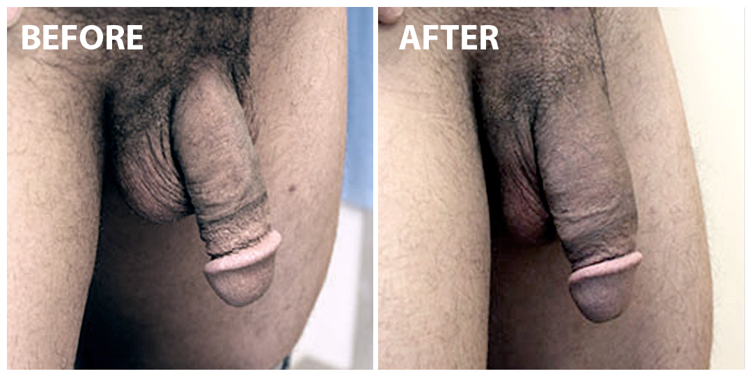 Penis Enlargement Before After Penis Enlargement Before After
