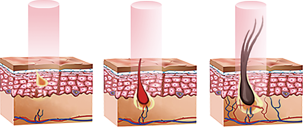 Premier-Signature-Hair-Growth-Laser Premier-Signature-Hair-Growth-Laser