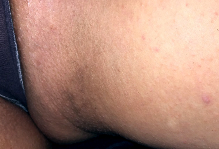 Fractional Laser for Private Part Discoloration Fractional Laser for Private Part Discoloration