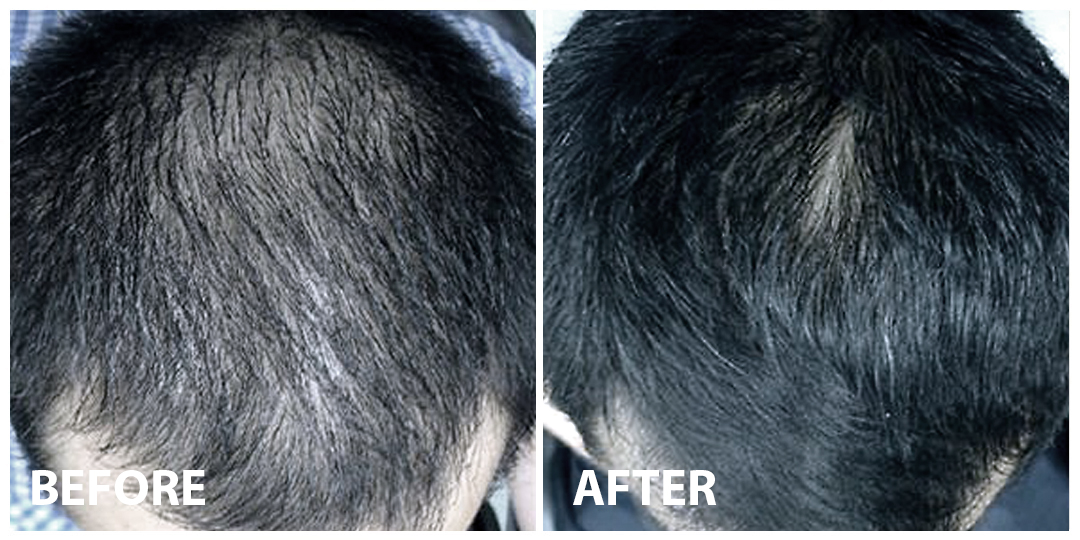 HAIR GROWTH LASER Before After 01 HAIR GROWTH LASER Before After