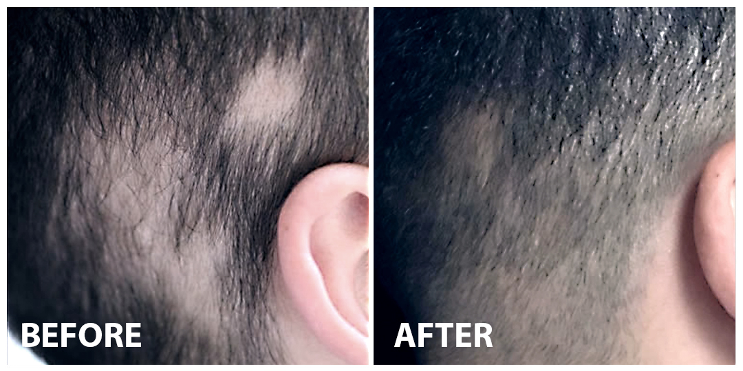 HAIR GROWTH LASER Before After 02 HAIR GROWTH LASER Before After