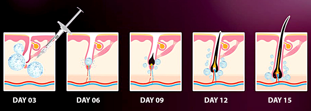 Hair Filler 05