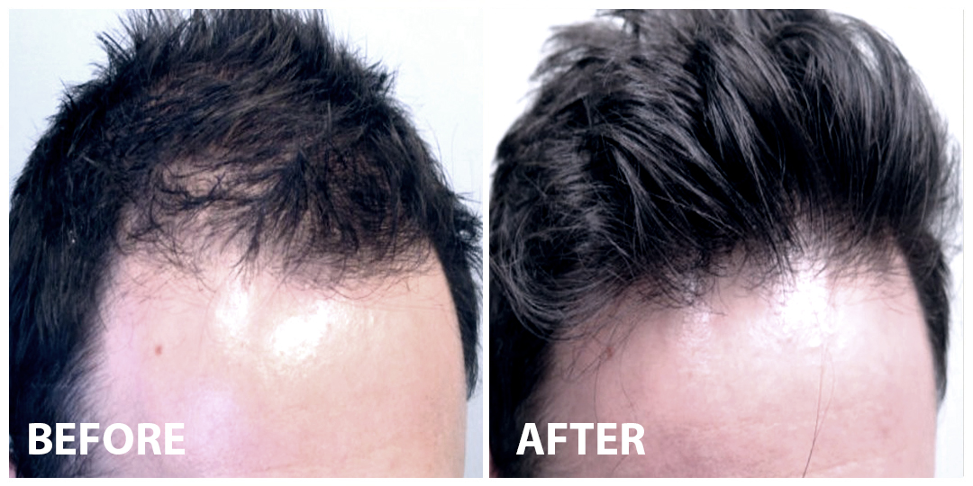 Hair Filler Before After 01 Hair Filler Before After