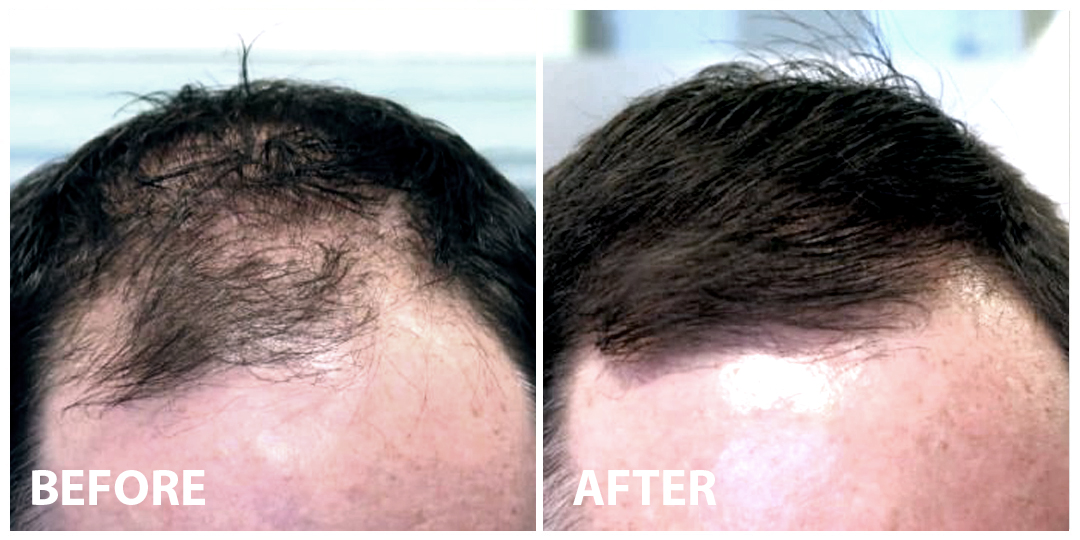 Hair Filler Before After 02 Hair Filler Before After