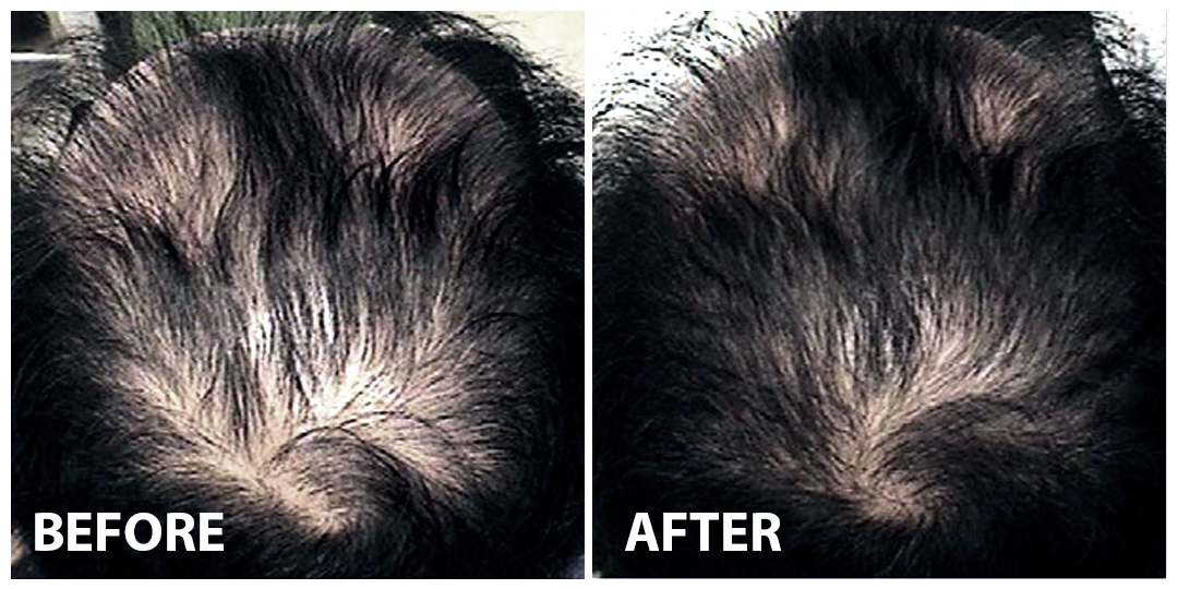 Hair Filler Before After 03 Hair Filler Before After