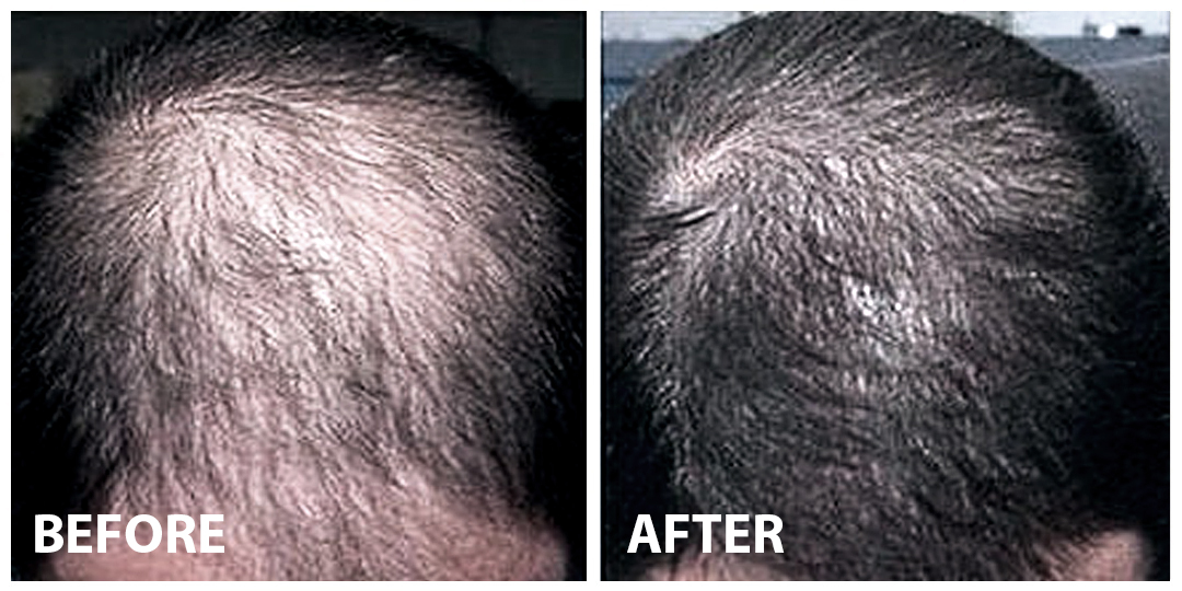 Hair Filler Before After 04