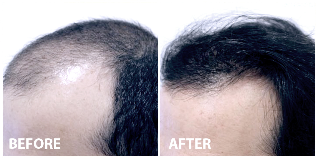 Hair Mesotherapy Before After 01 Hair Mesotherapy Before After