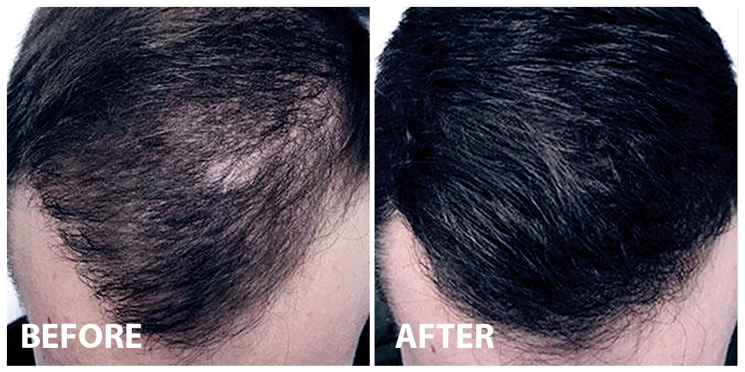 Hair Mesotherapy Before After 02 Hair Mesotherapy Before After