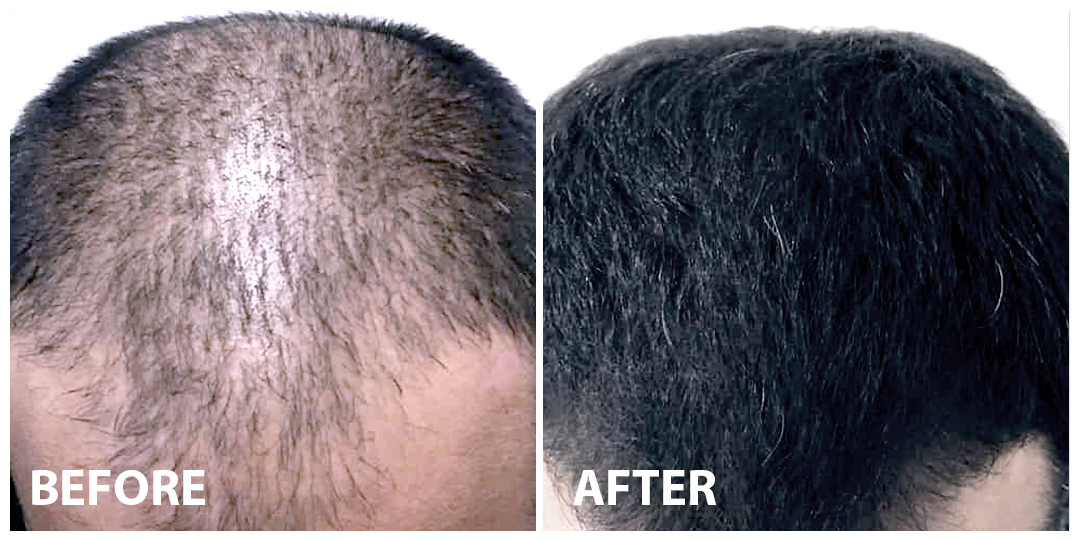 Hair Mesotherapy Before After 03 Hair Mesotherapy Before After