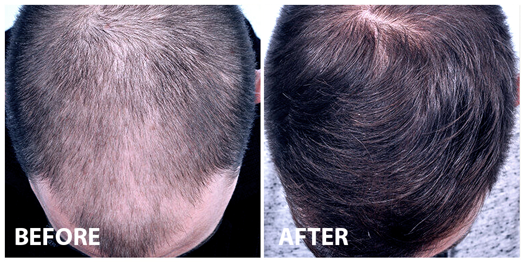 Hair Mesotherapy Before After 04 Hair Mesotherapy Before After