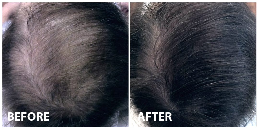 Hair PRP Before After 01 Hair PRP Before After