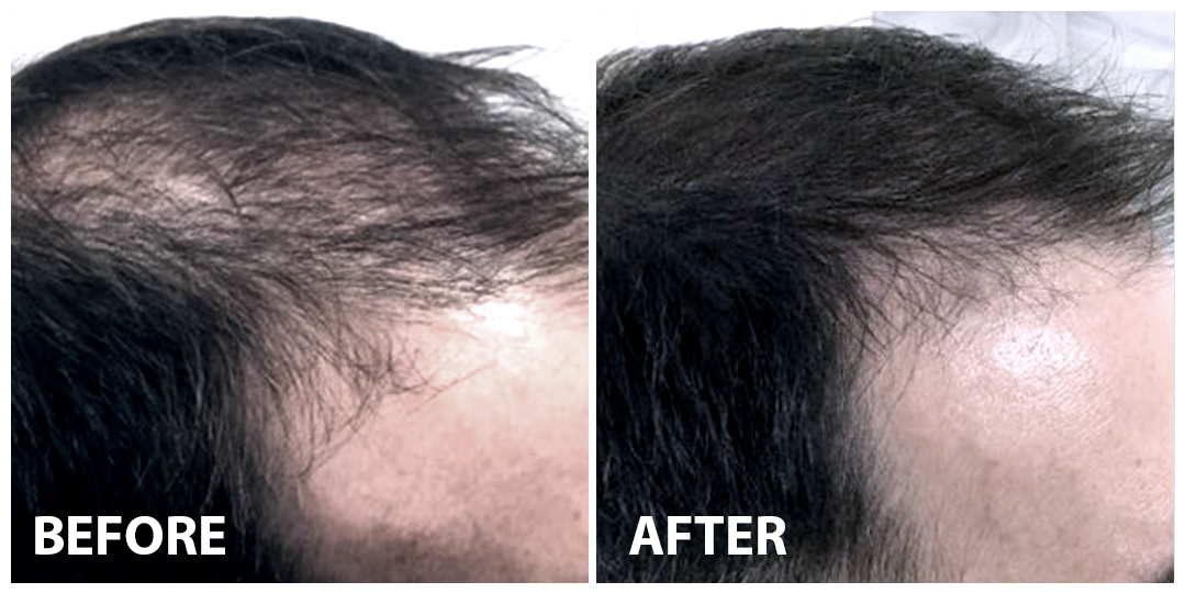 Hair PRP Before After 02 Hair PRP Before After