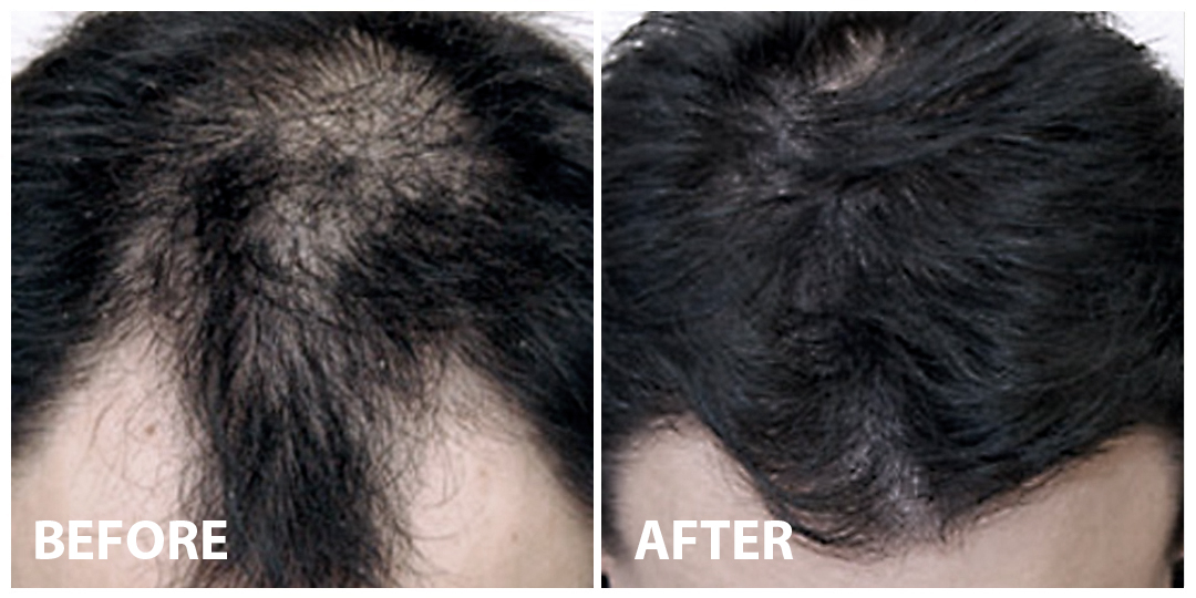Hair PRP Before After 04