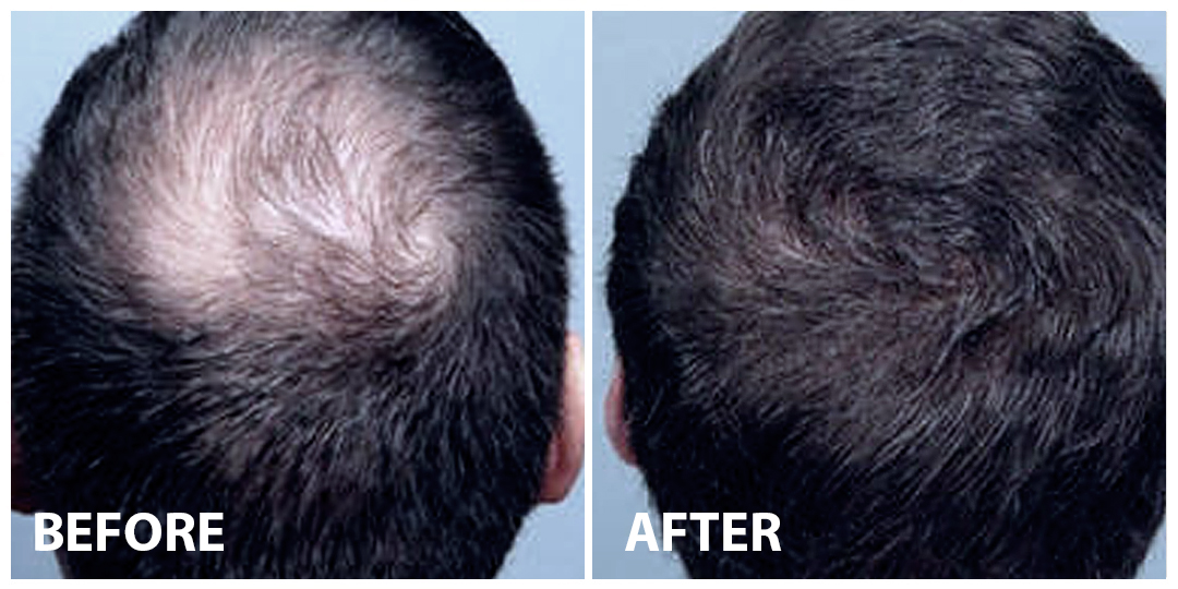 Hair Stem Cells Before After 02 Hair Stem Cells Before After