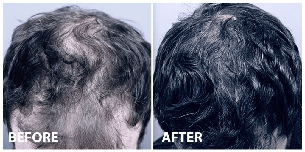 Hair Stem Cells Before After