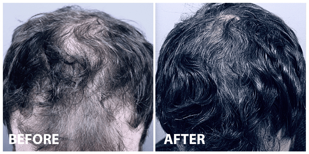 Hair Stem Cells Before After 03 Hair Stem Cells Before After