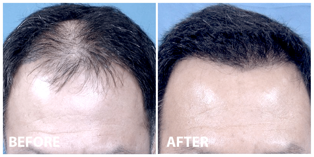 Hair Stem Cells Before After 04