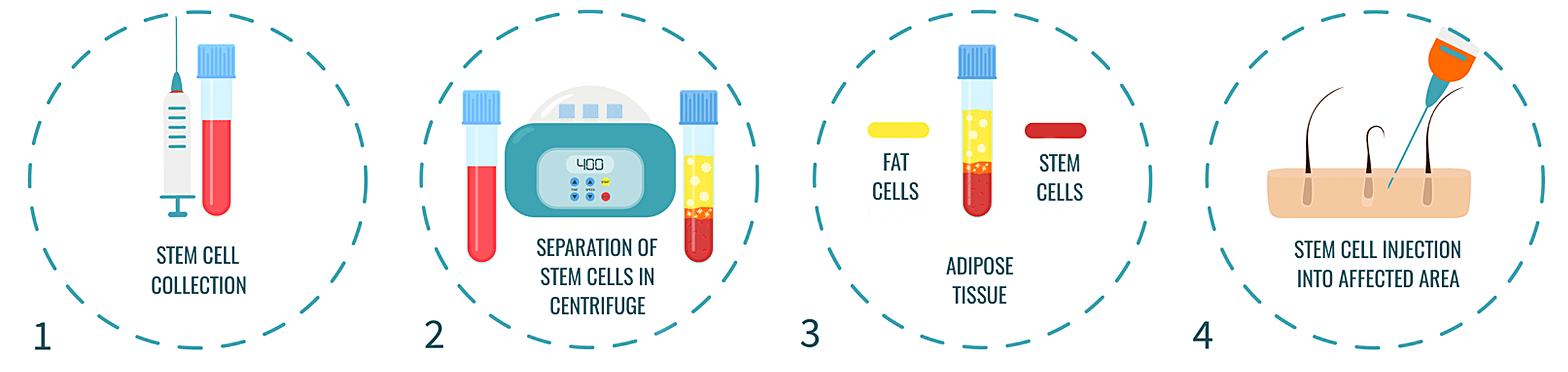 Hair StemCells works How does Stem Cell Hair Transplant work?