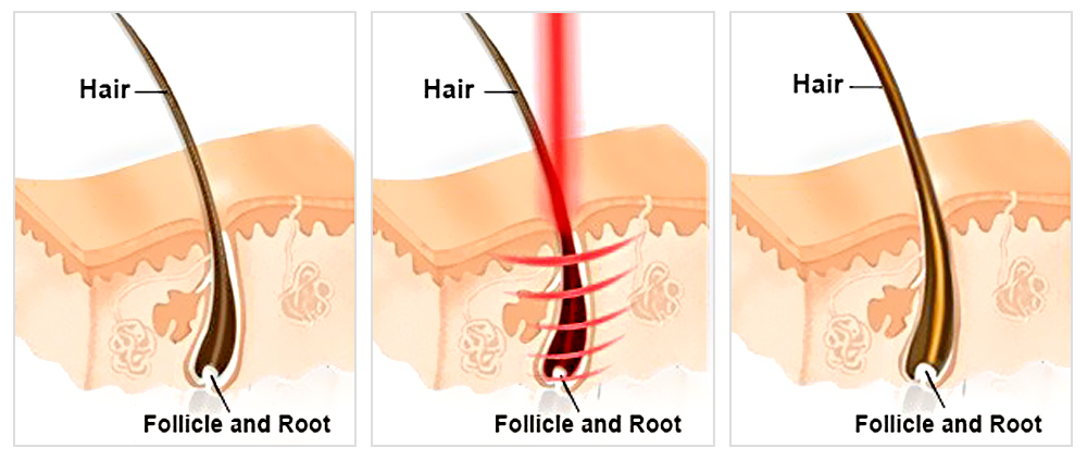 How does hair mesotherapy work How does hair mesotherapy work?