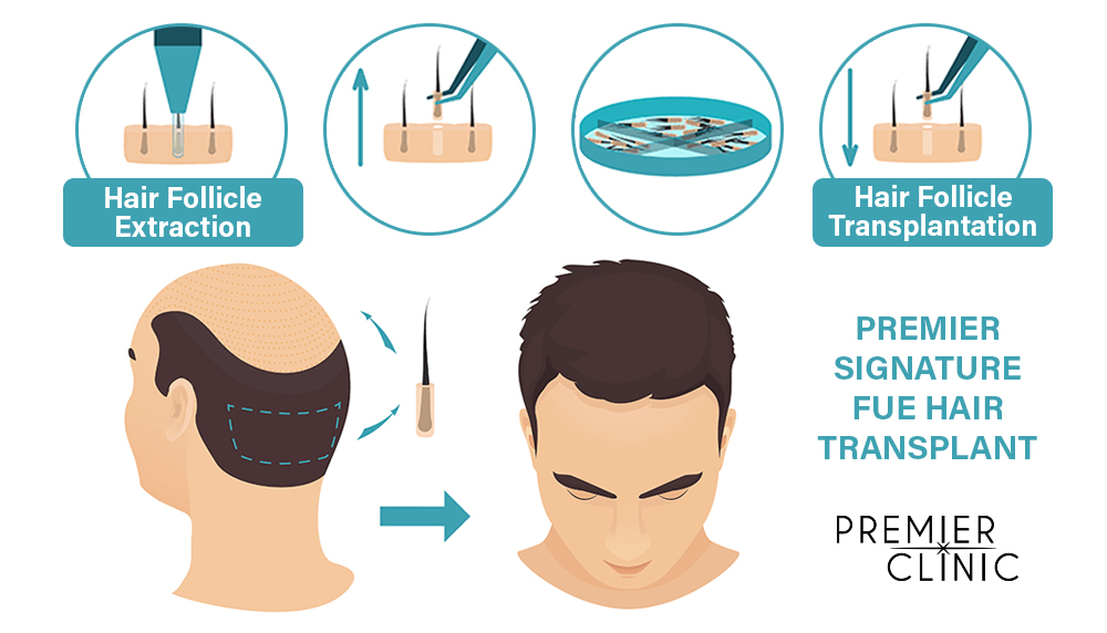 PREMIER SIGNATURE FUE HAIR TRANSPLANT PREMIER SIGNATURE FUE HAIR TRANSPLANT
