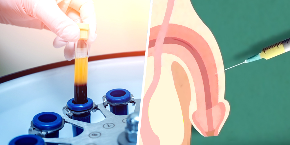 Penis PRP 04 dick enlargement
