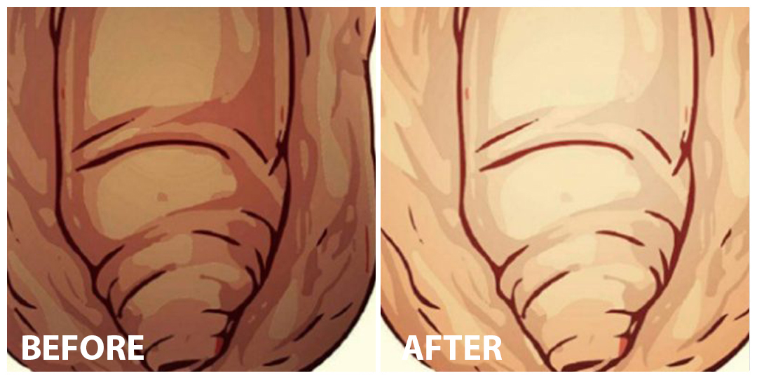 Penis whitening Before After Penis whitening Before After
