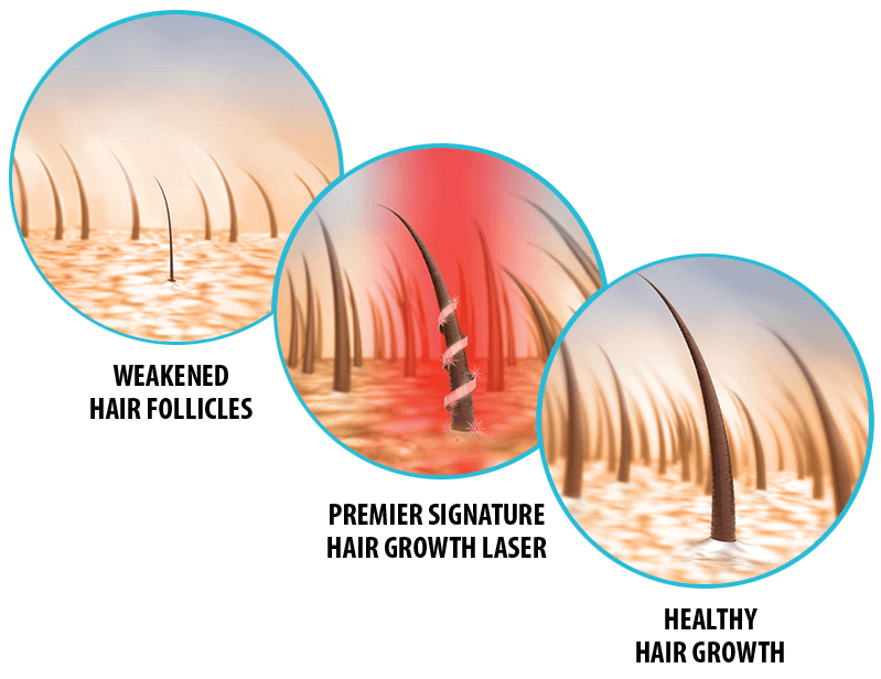 Premier-Signature-Hair-Growth-Laser