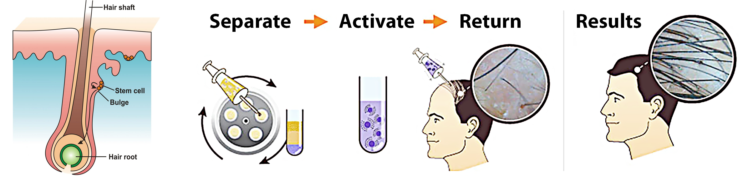 Untitled-1-1140×400 How does Stem Cell Hair Transplant work?