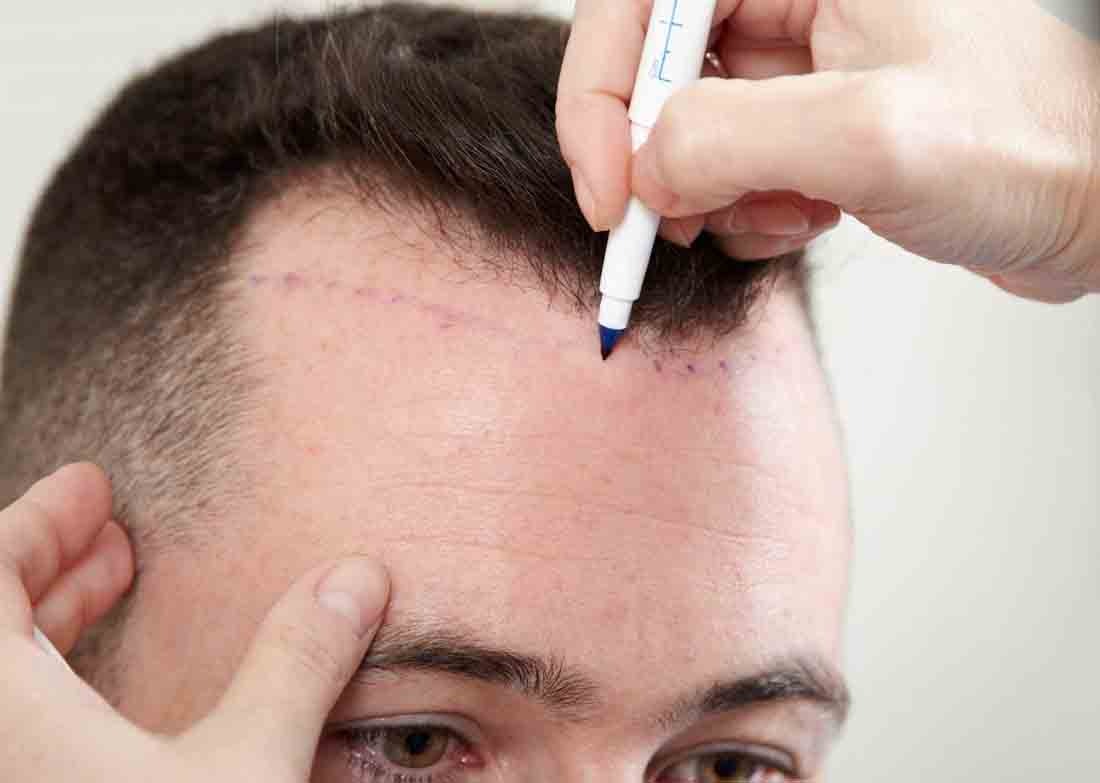 best-hair-transplant-clinics-gurgaon