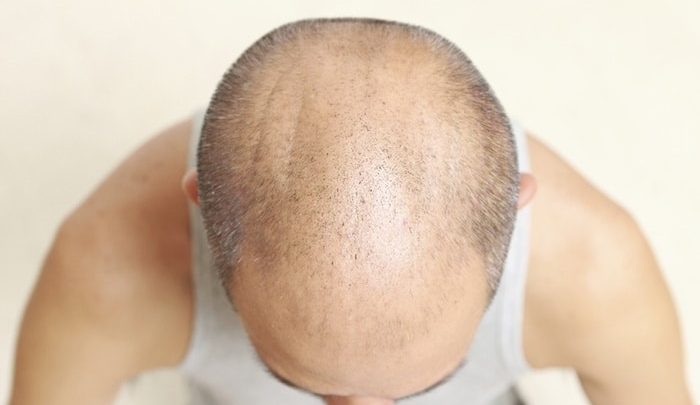 Perception of Hair Loss In Asia Perception of Hair Loss In Asia