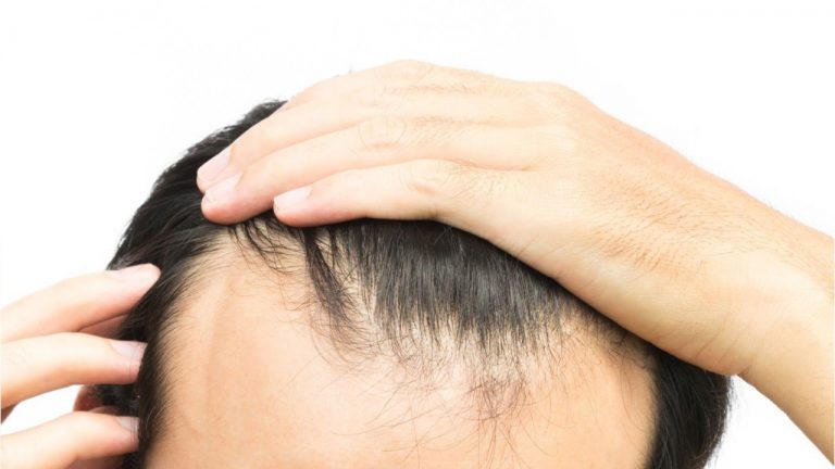 Stem Cell Hair Treatment Stem Cell Hair Treatment