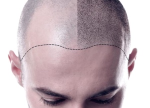 PENANAMAN RAMBUT 