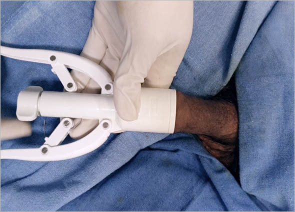 ZSR Circumcision at Premier Clinic 04