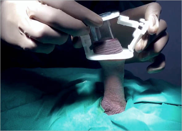 ZSR Circumcision at Premier Clinic 06 CIRCUMCISION WITHOUT KNIFE
