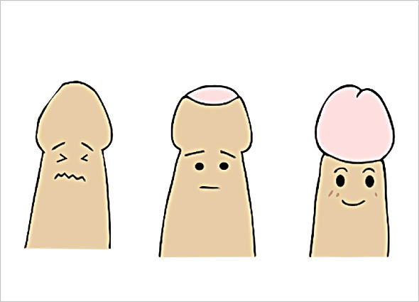 benefits of ZSR Circumcision