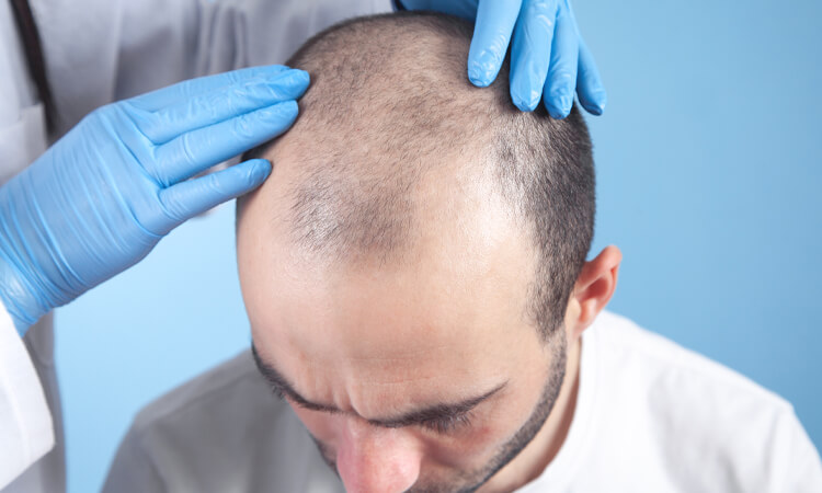 Hair Transplant