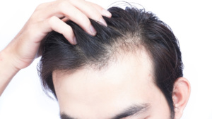 The Quantity of Hair Removed