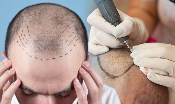 Getting A Hair Transplant Done In KL