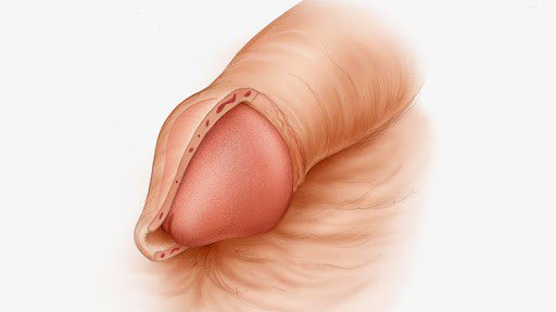 Adult Male Circumcision