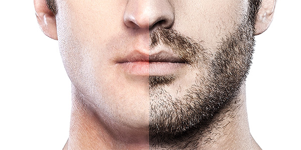 Unlock Your Handsome Potential : FUE Beard Transplant