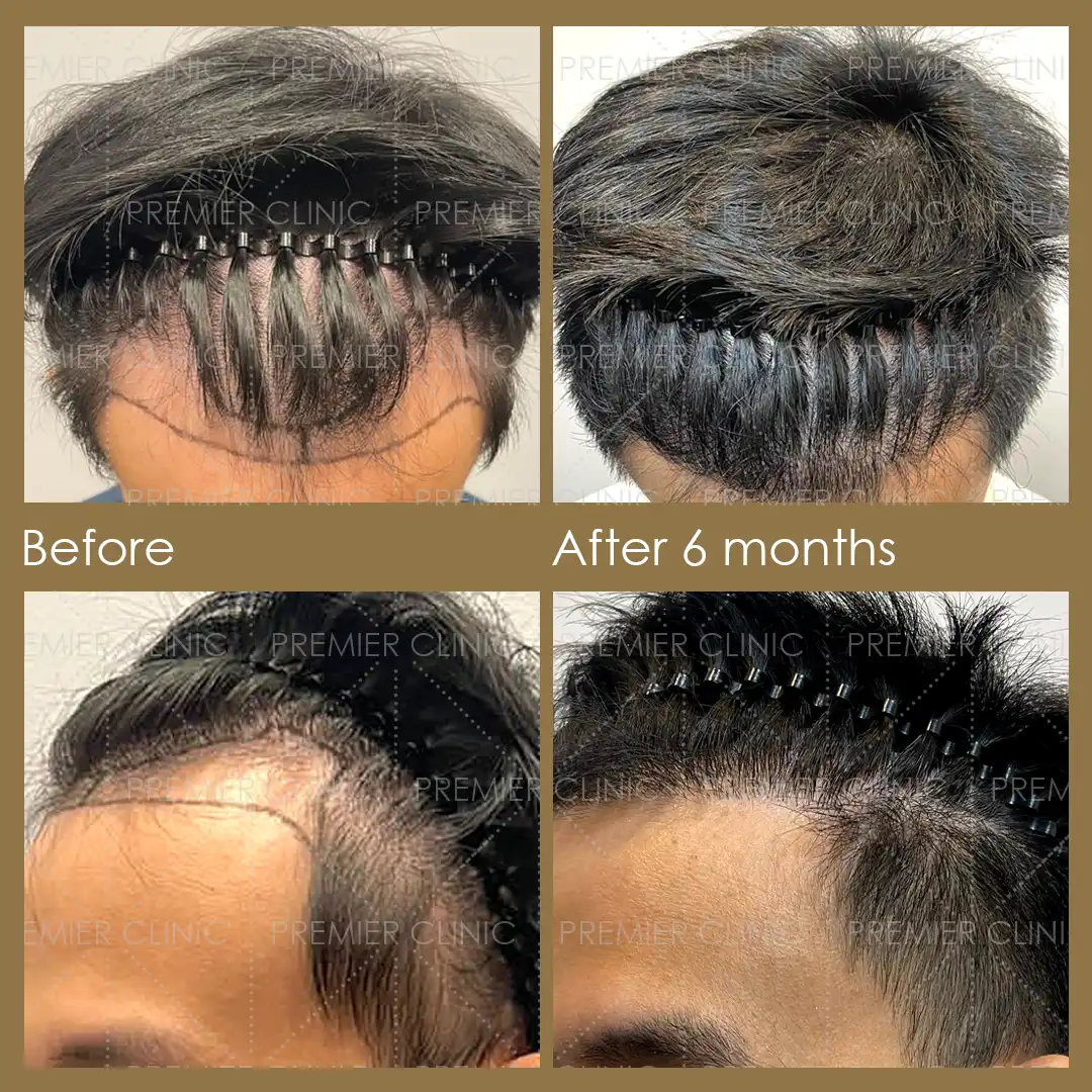 1080 X 1080 Premier FUE Before & After 01 Premier FUE Before & After