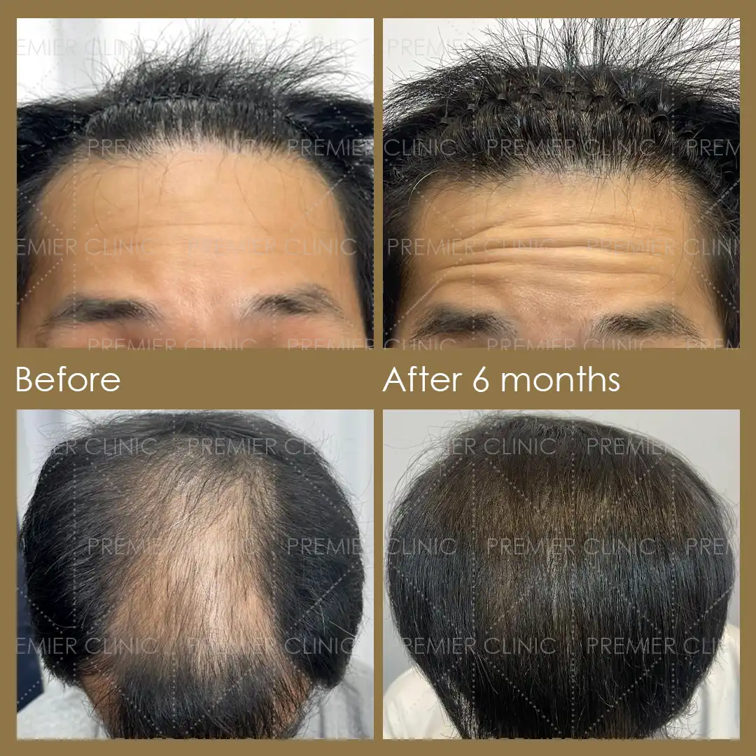 1080 X 1080 Premier FUE Before & After 02 Premier FUE Before & After