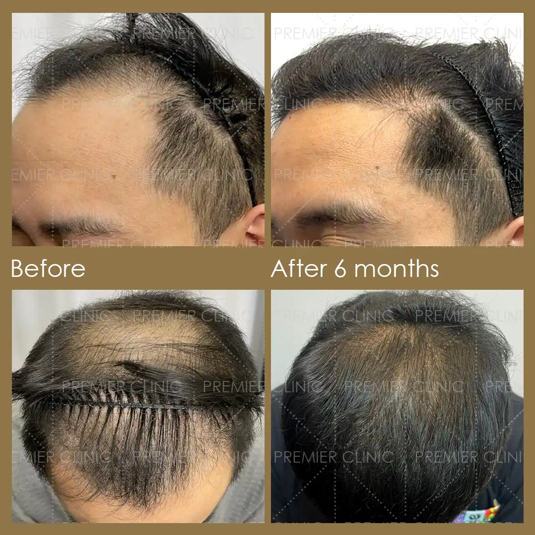 1080 X 1080 Premier FUE Before & After 03 Premier FUE Before & After