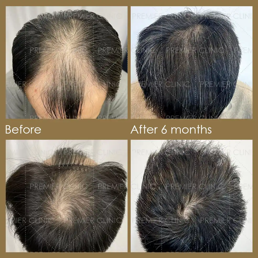 1080 X 1080 Premier FUE Before & After 04 Premier FUE Before & After