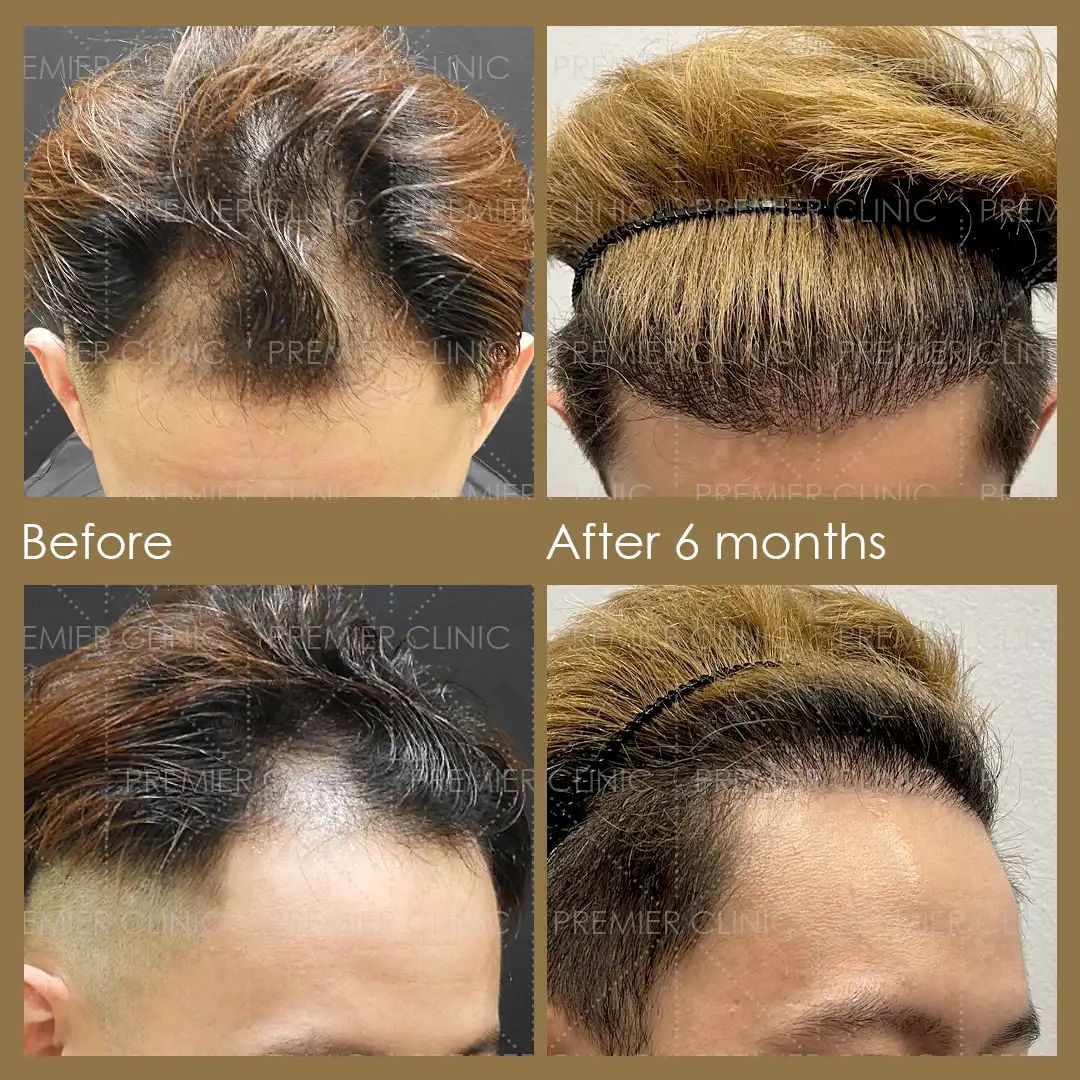 1080 X 1080 Premier FUE Before & After 05 Premier FUE Before & After