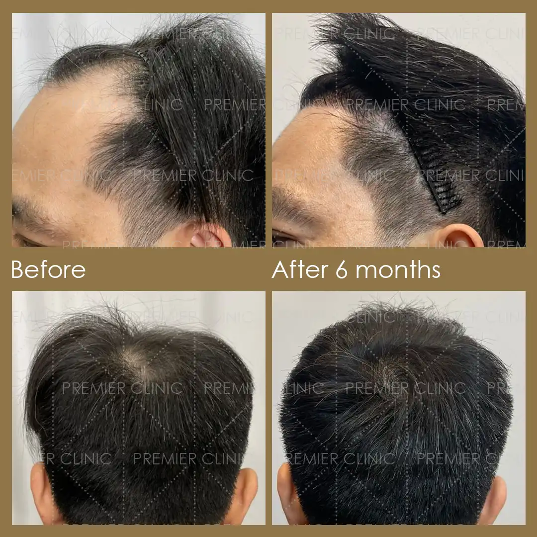 1080 X 1080 Premier FUE Before & After 06 Premier FUE Before & After