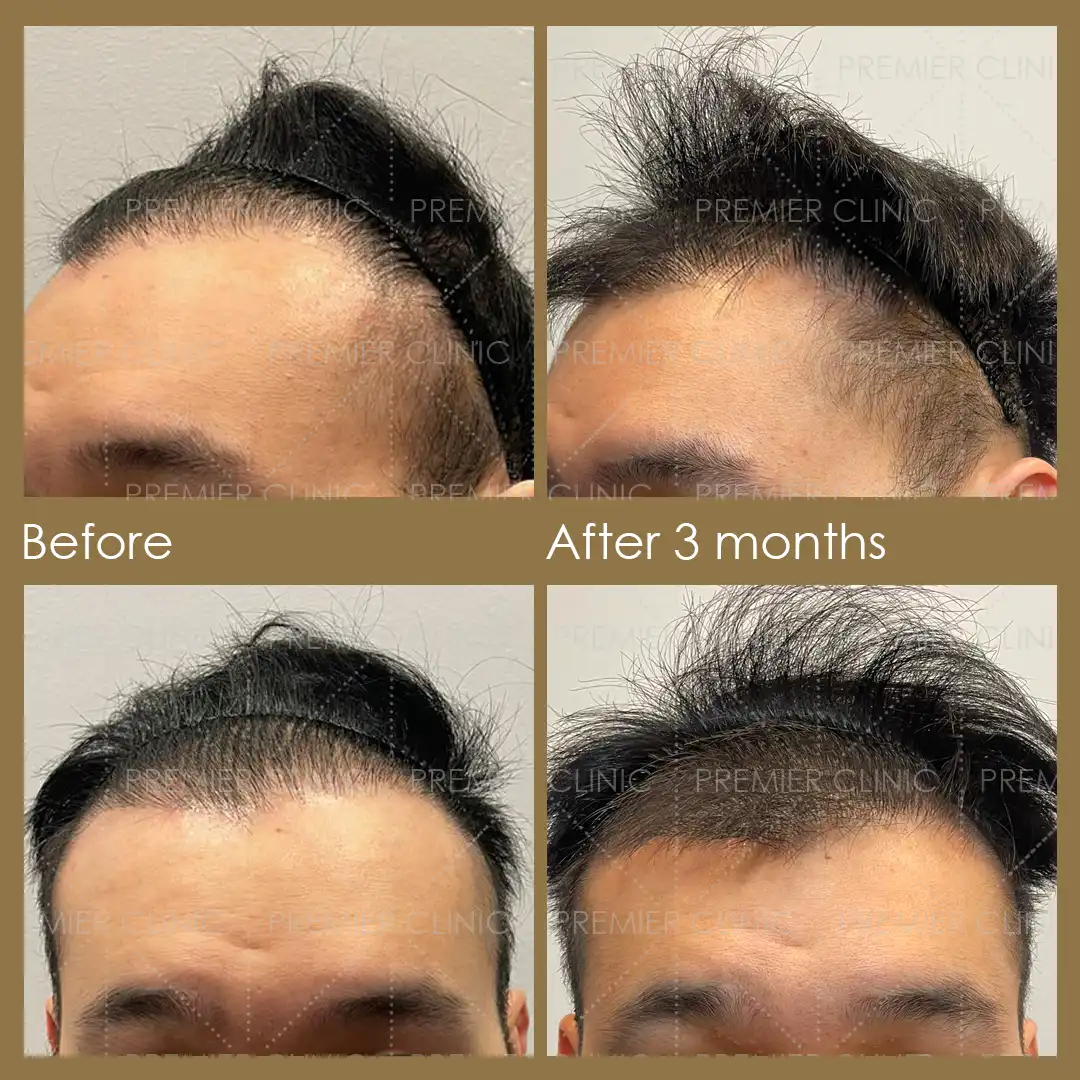 1080 X 1080 Premier FUE Before & After 07 Premier FUE Before & After
