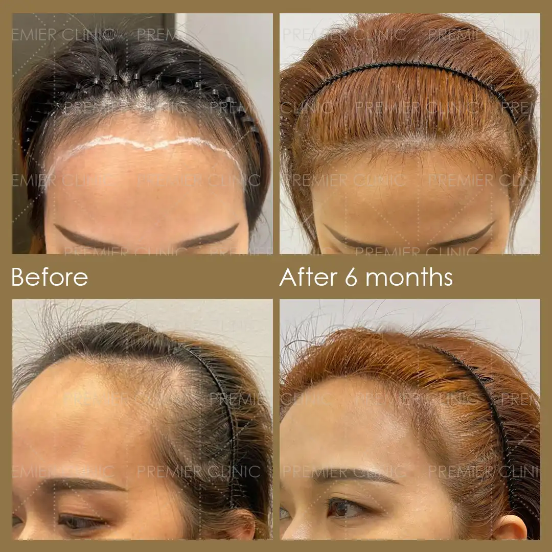 1080 X 1080 Premier FUE Before & After 08 Premier FUE Before & After