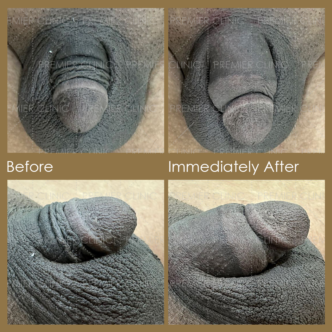 1080 X 1080 Premier Penis Enlargement Filler Before & After 02